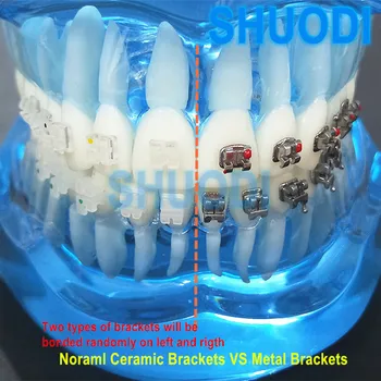 Стоматологическая ортодонтическая прозрачная модель зубов с обычными керамическими и металлическими брекетами сверху и снизу для общения с пациентом