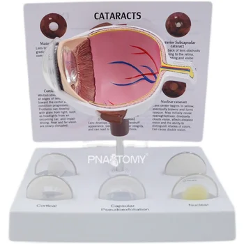 Съемная модель анатомии глаза, Модель Патологии глазного яблока при Катаракте